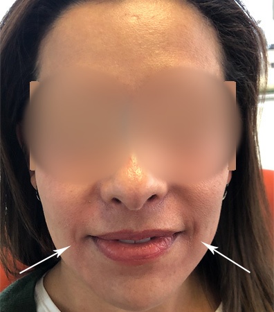 Rellenos faciales