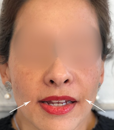 Rellenos faciales
