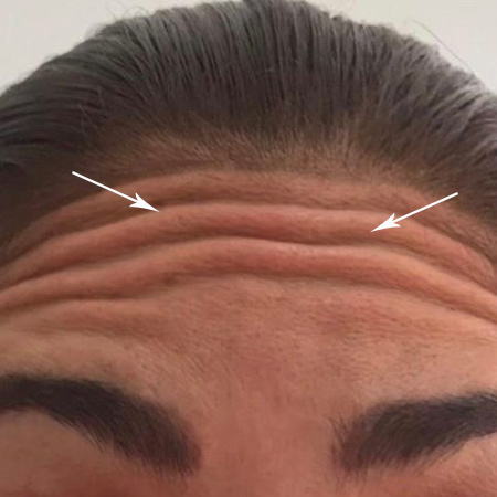 Aplicación de Botox
