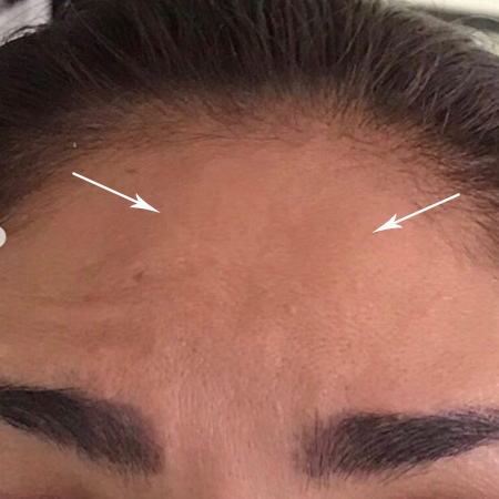 Aplicación de Botox