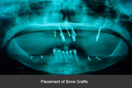 Dental implant case