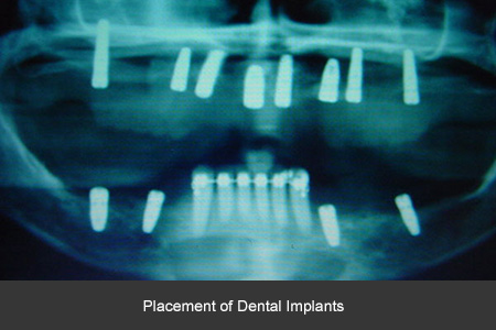 Dental implant case