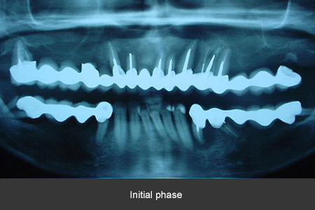 Dental implant case