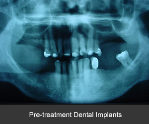 Dental implant case