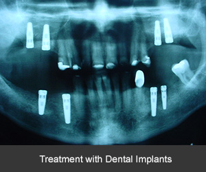 Dental implant case