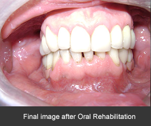 Oral rehabilitation