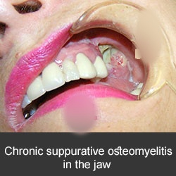 tratamiento de las infecciones dentales y cérvico faciales