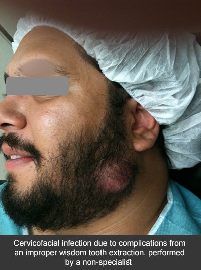 Diagnóstico y tratamiento de las infecciones dentales