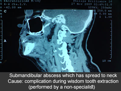 Diagnóstico y tratamiento de las infecciones dentales