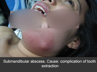 Diagnóstico y tratamiento de las infecciones dentales en CDMX