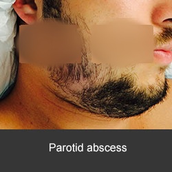 tratamiento de las infecciones dentales y cérvico faciales