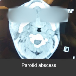 tratamiento de las infecciones dentales y cérvico faciales