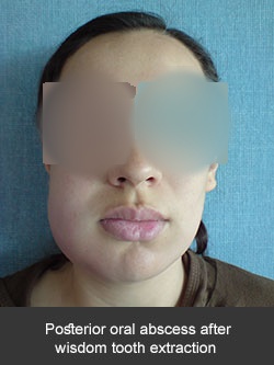 Absceso bucal posterior a la extracción de un tercer molar
