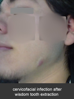 Actinomicosis cervico-facial post extracción de tercer molar