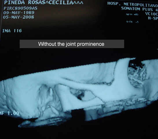 Articular eminence (clinical case)