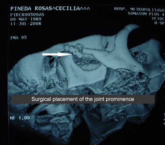 Articular eminence (clinical case)