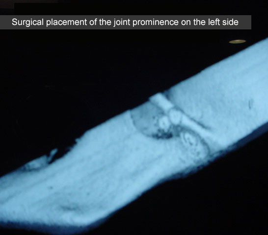 Articular eminence (clinical case)