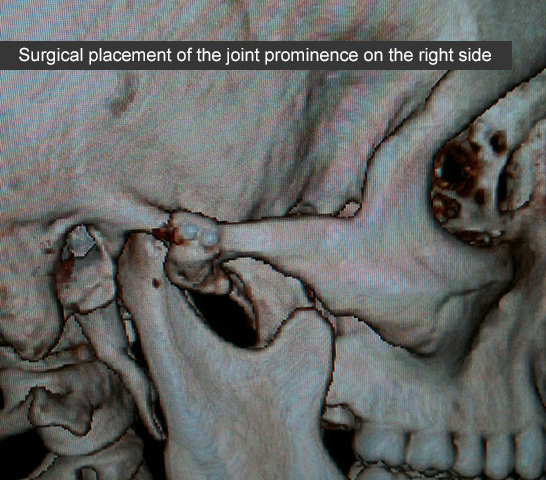Articular eminence (clinical case)