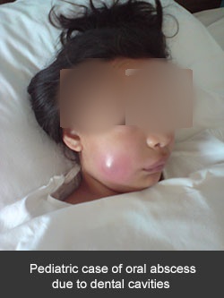Absceso bucal en paciente pediátrico por caries dental