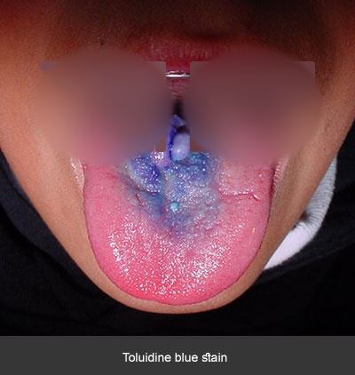 Tinzión con azul de toluidina - Cáncer bucal