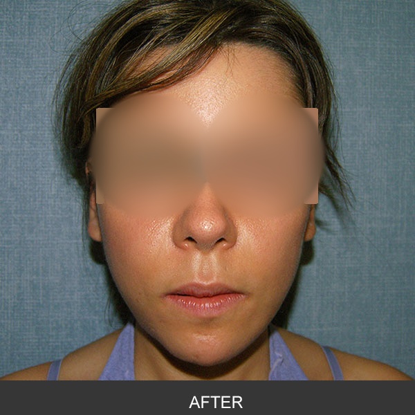 Removal of Silastic implant due to infection