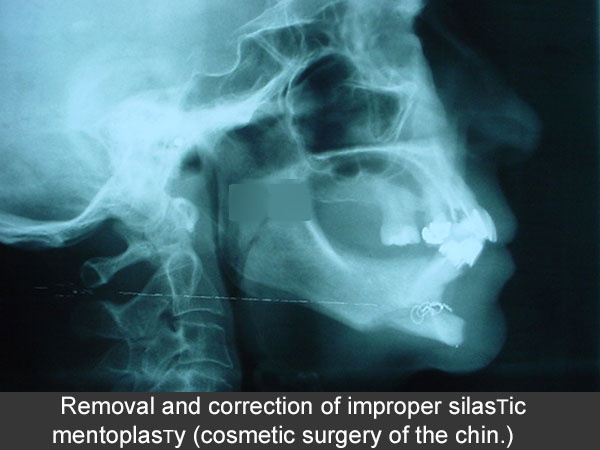 Silastic mentoplasty correction