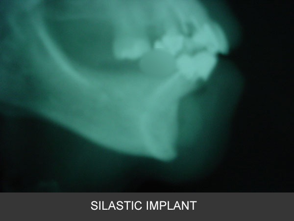 Silastic mentoplasty correction