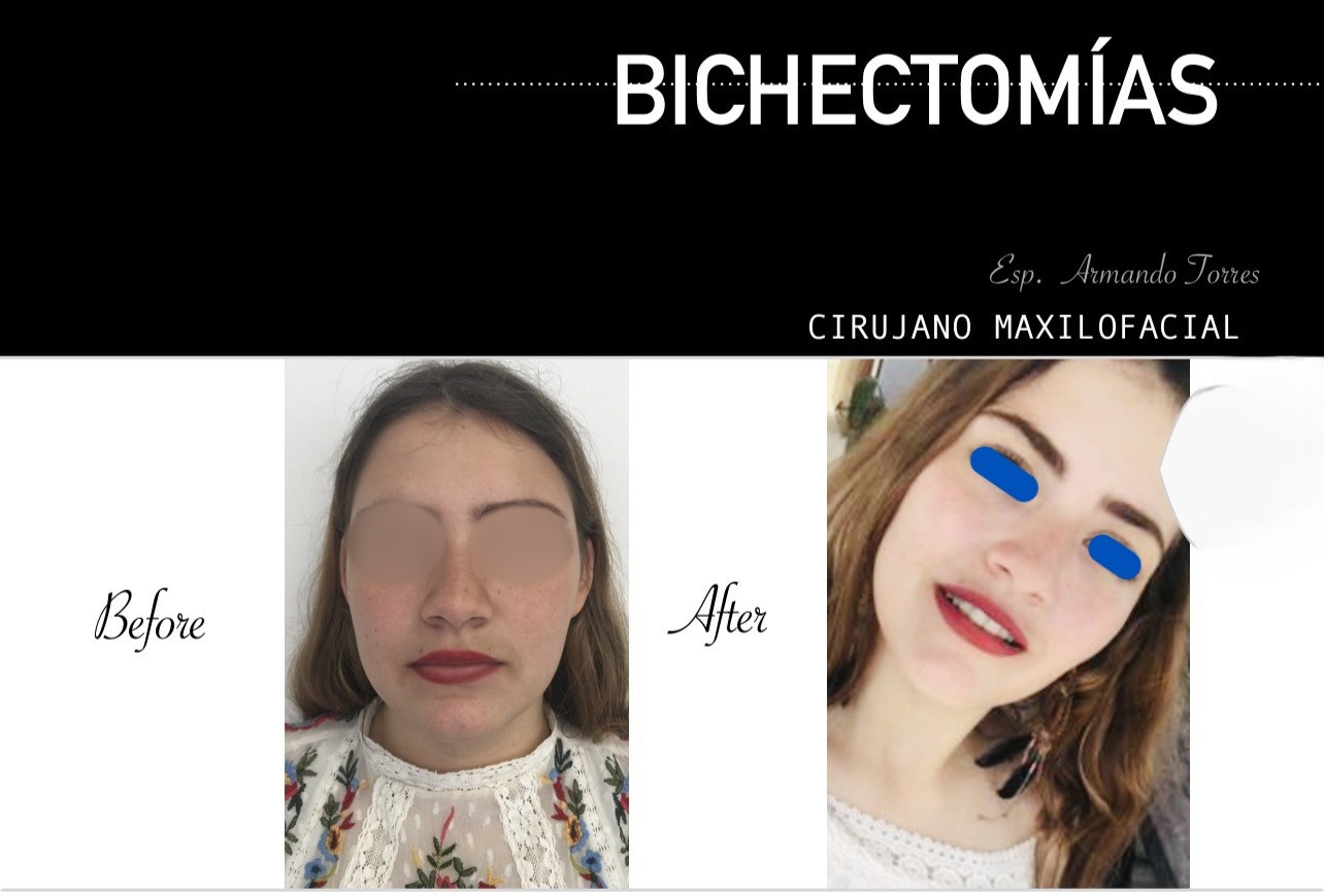 Caso clínico de bichectomía
