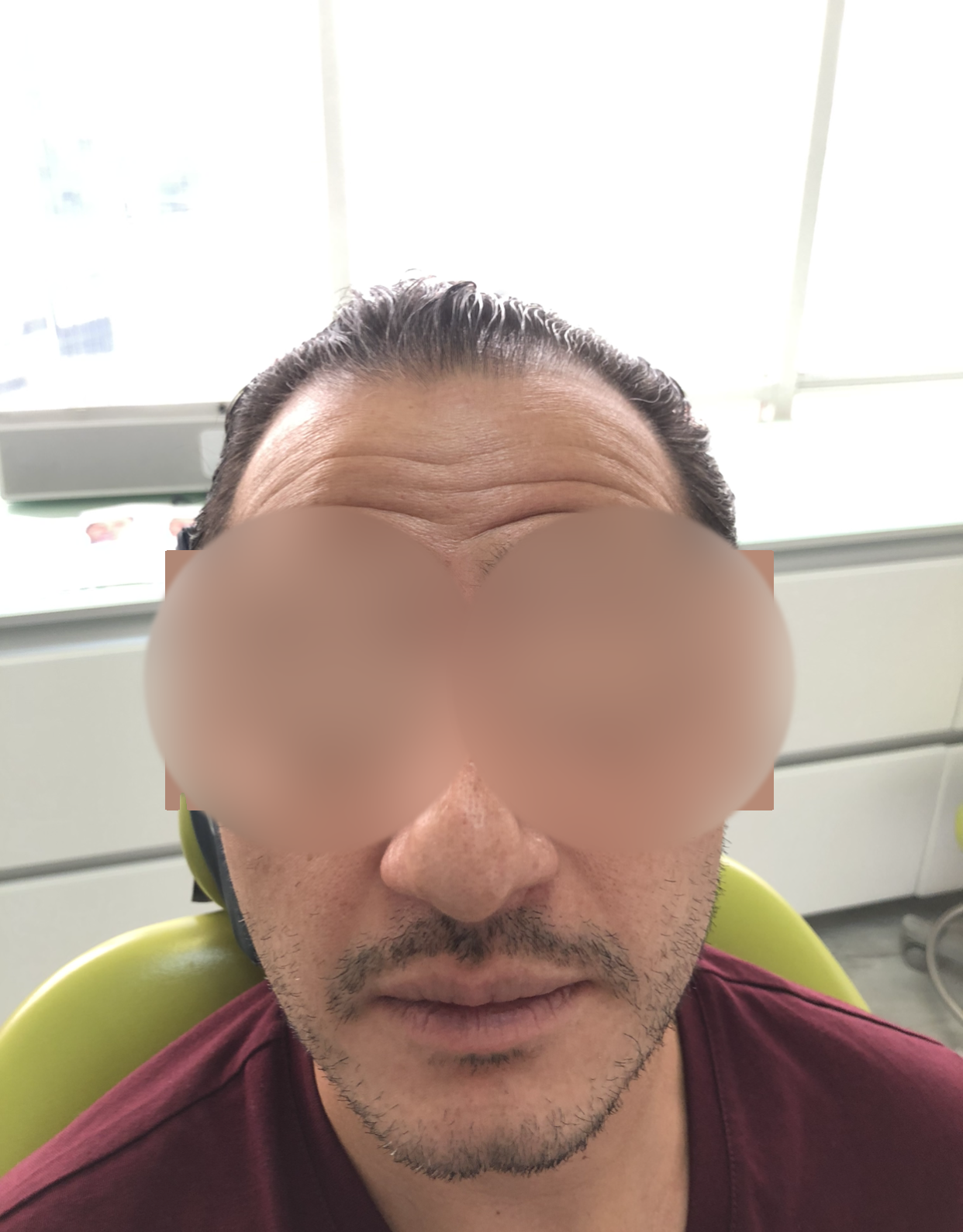 Caso de aplicación de Botox facial