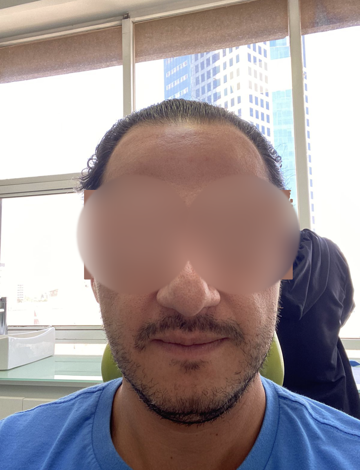 Caso de aplicación de Botox facial