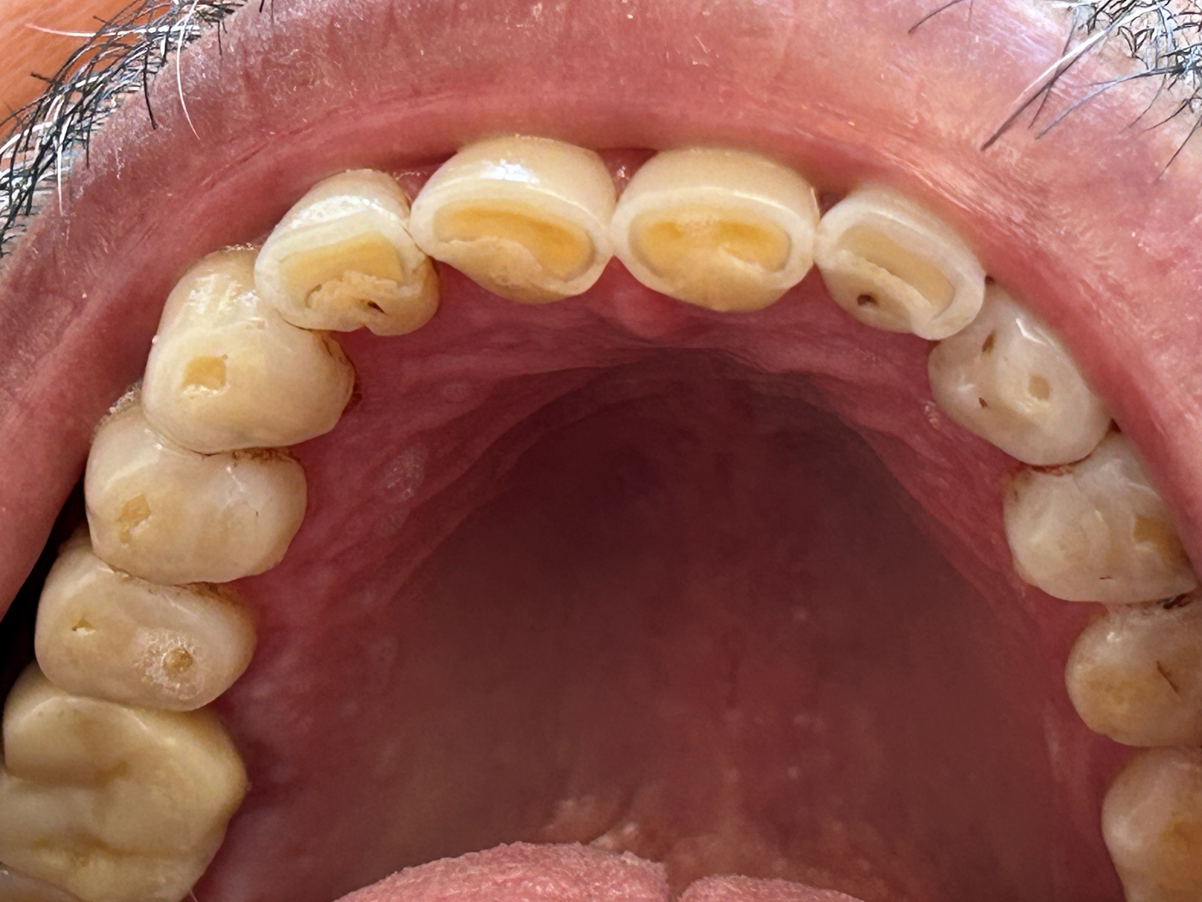 Teeth wear caused by bruxism