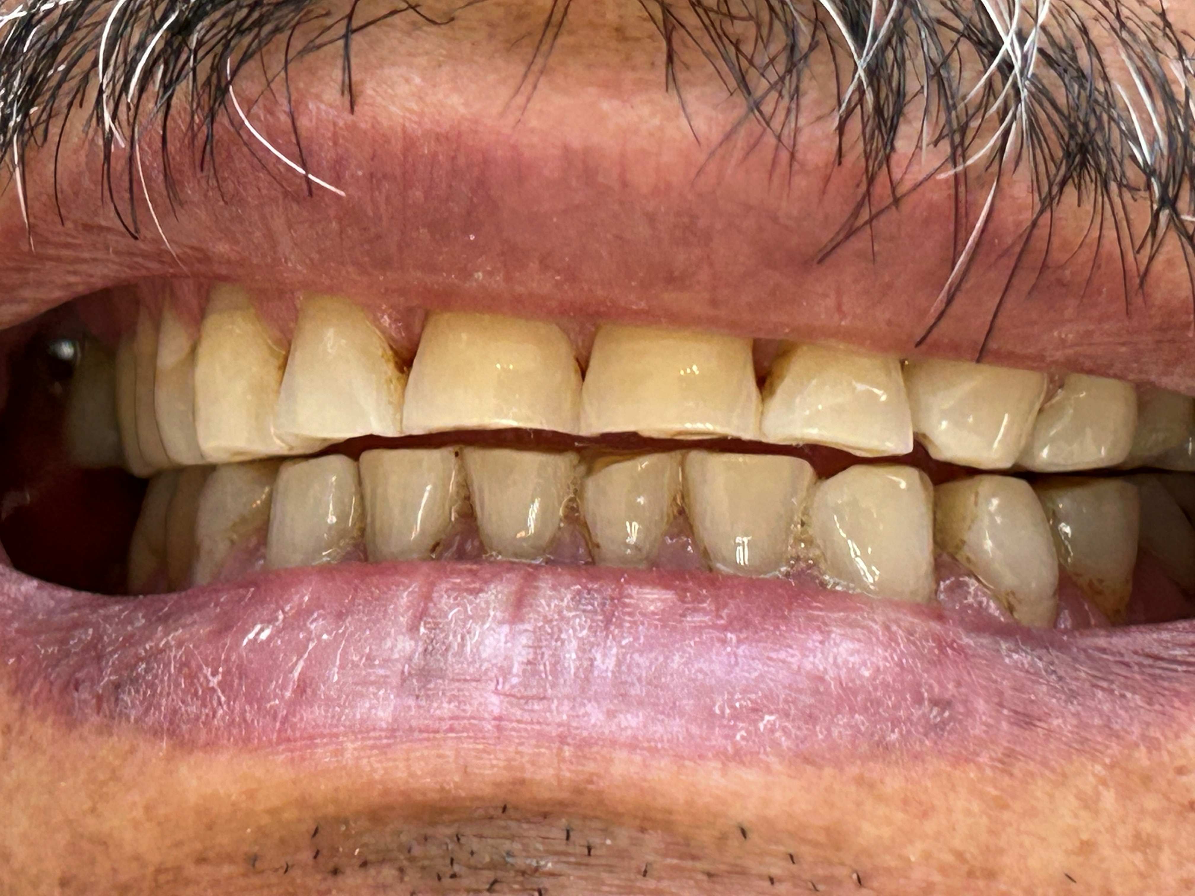 Teeth wear caused by bruxism
