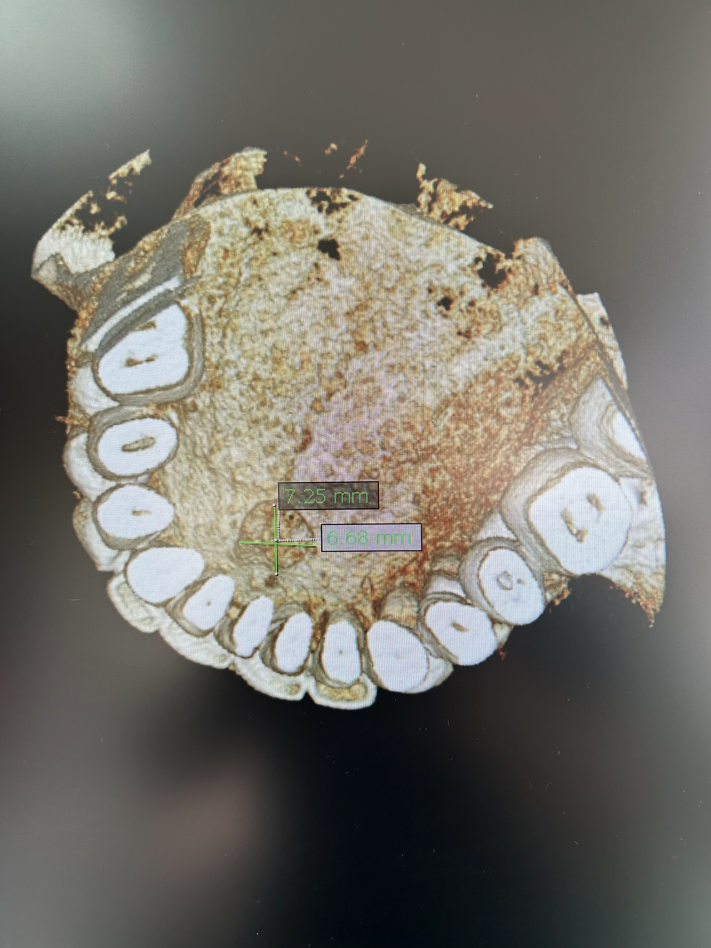 Teeth wear caused by bruxism