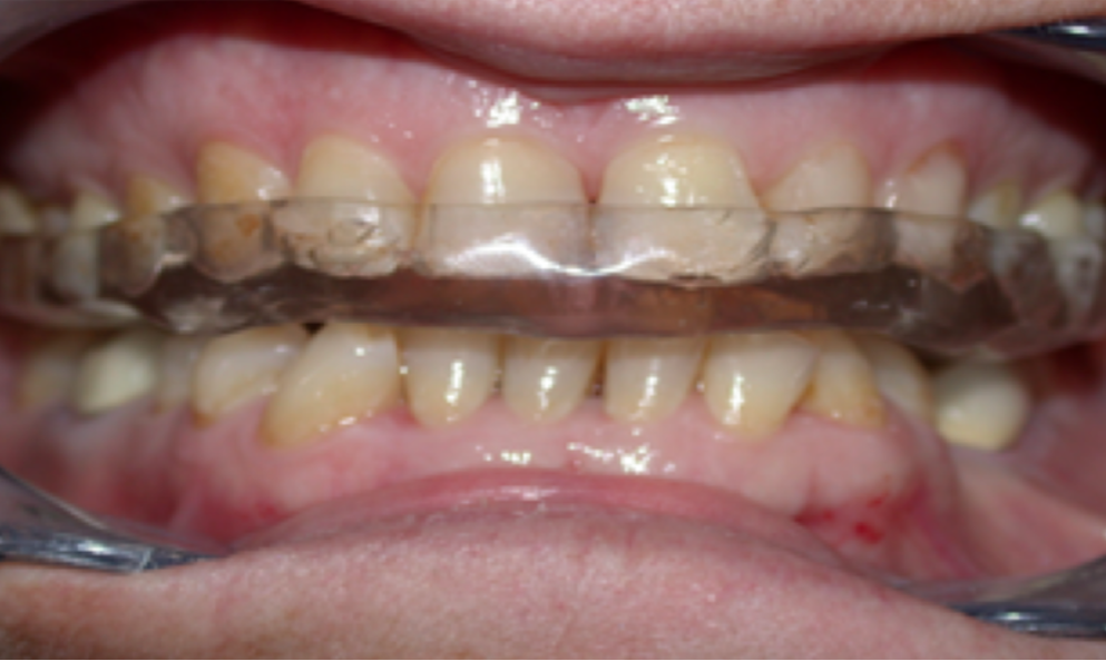 Occlusal guard