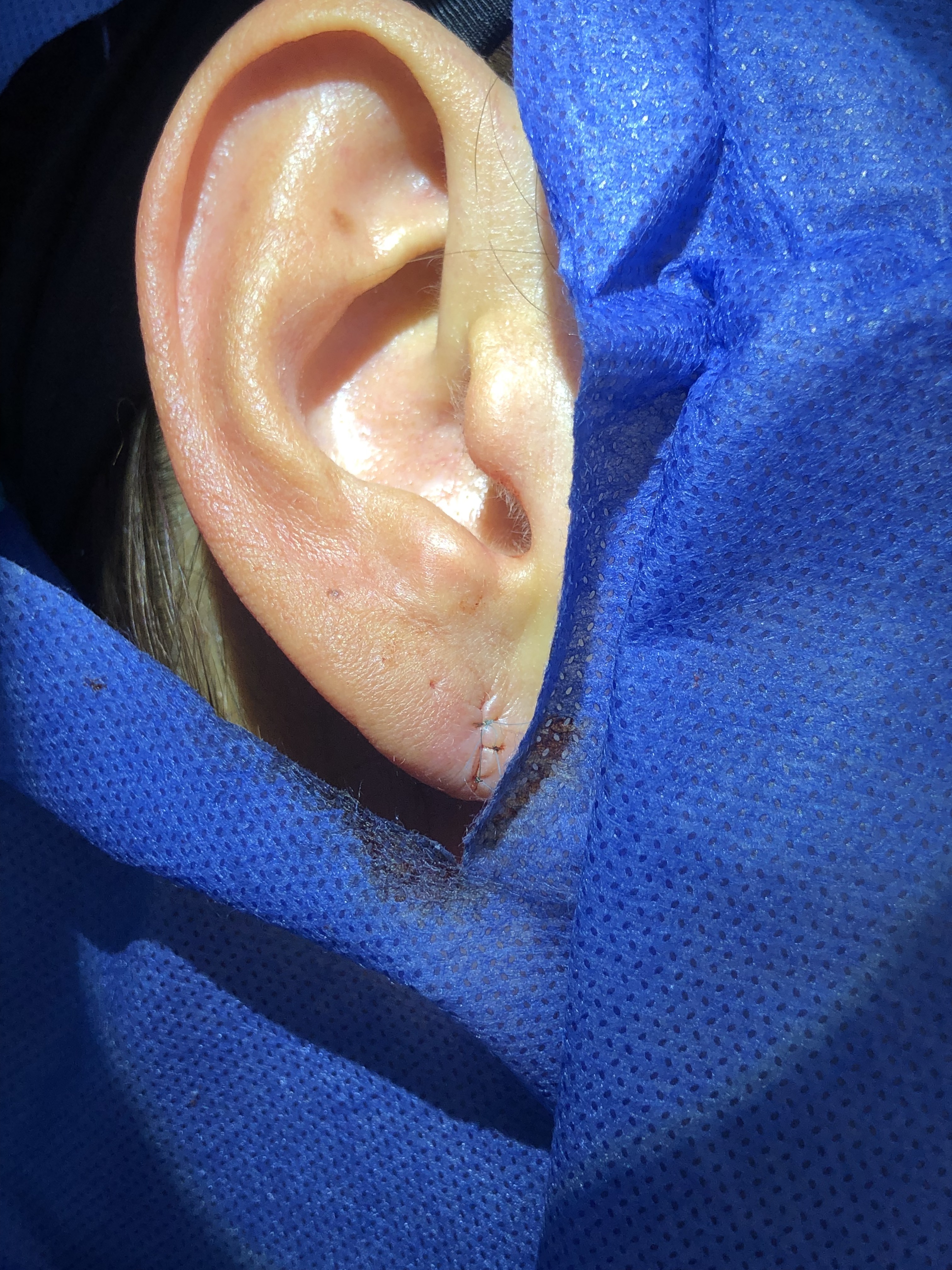 Ear piercing closure