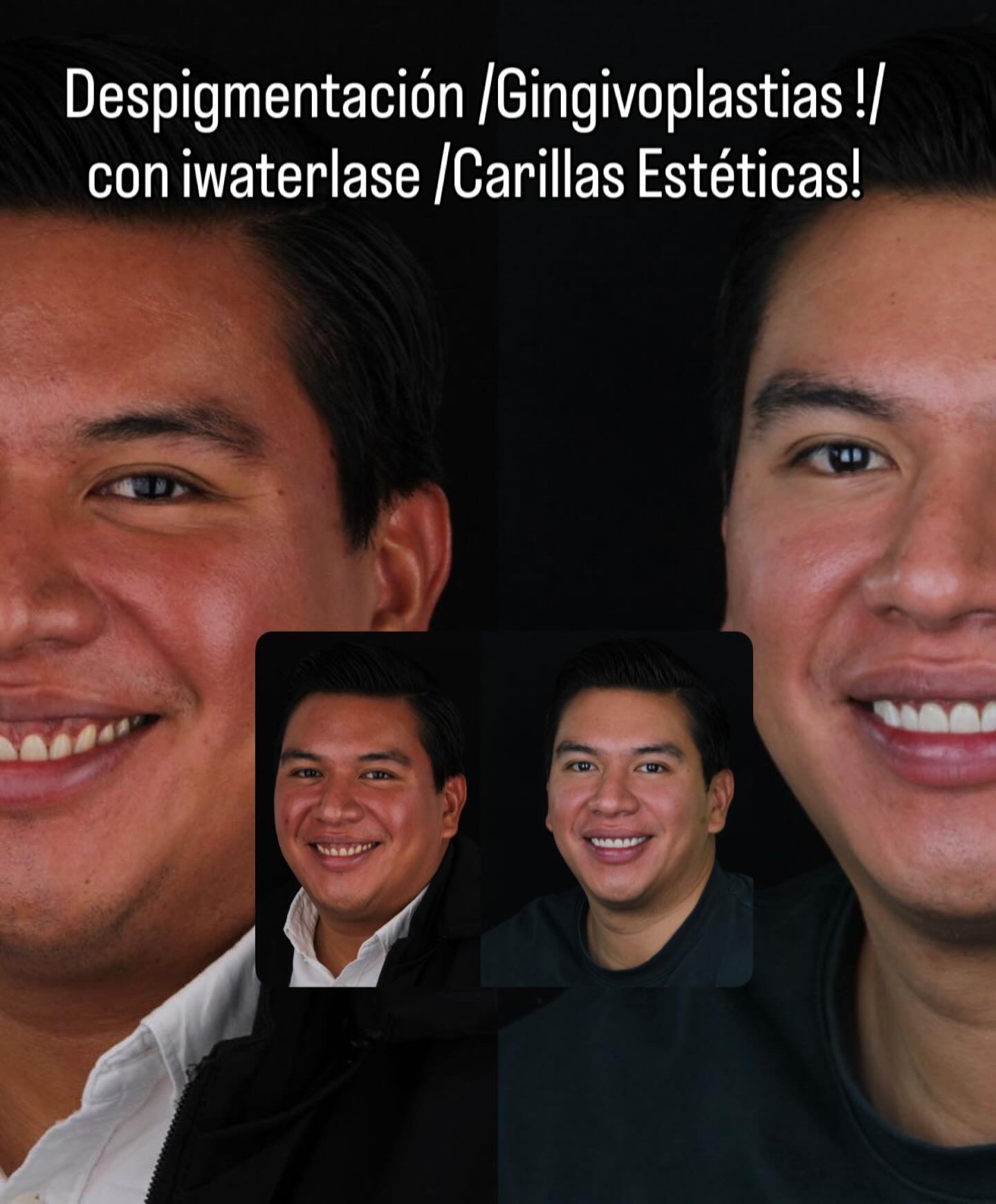 Laser gum depigmentation