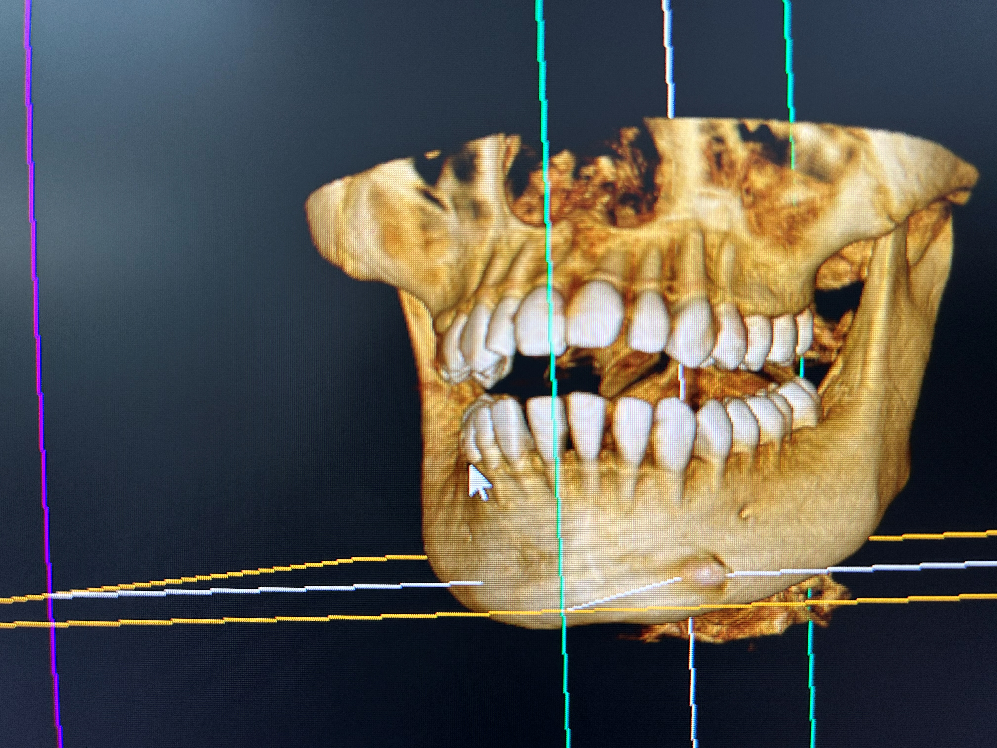 Dientes incluidos: caso clínico adicional