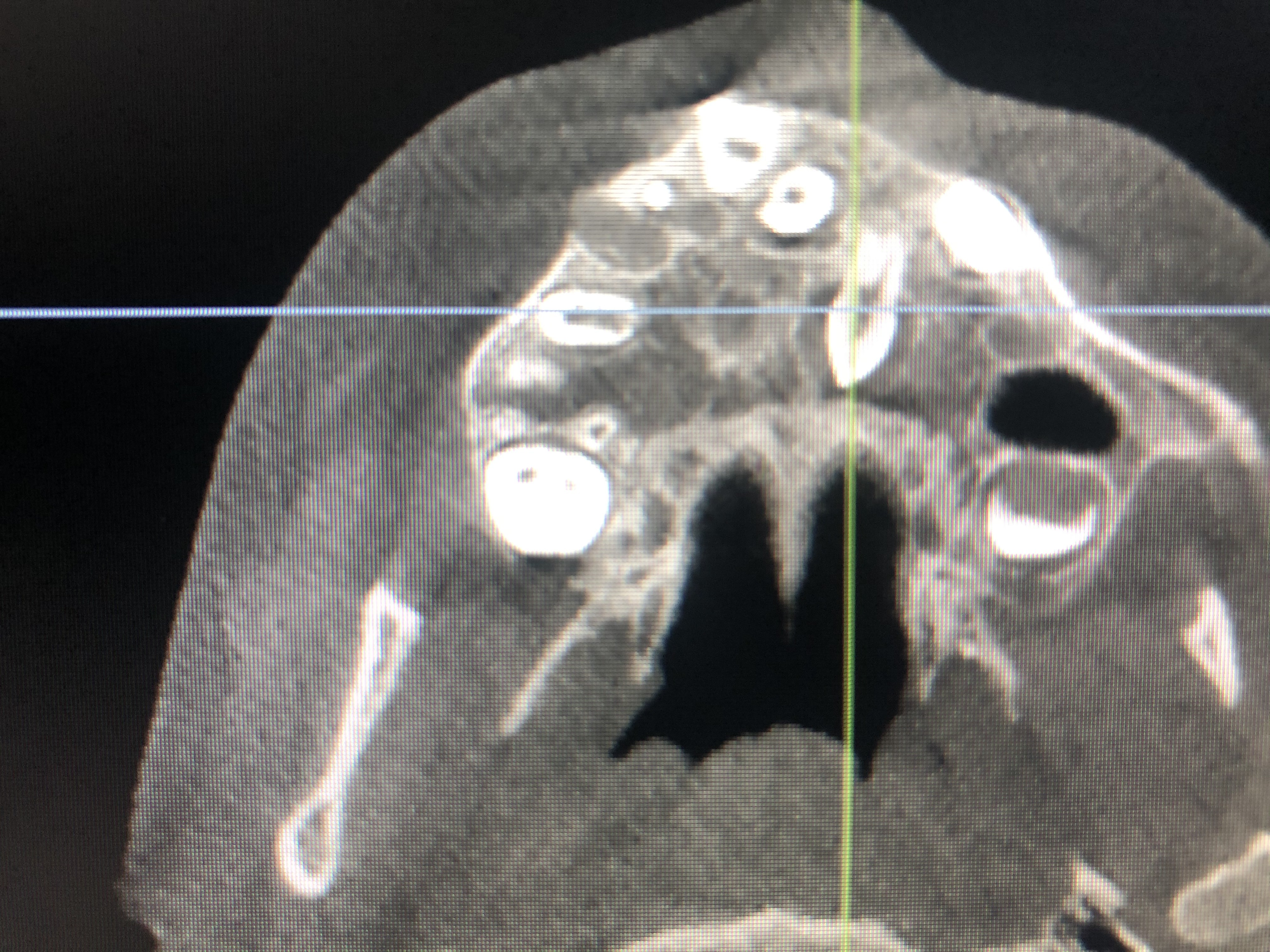 Caso de canino retenido