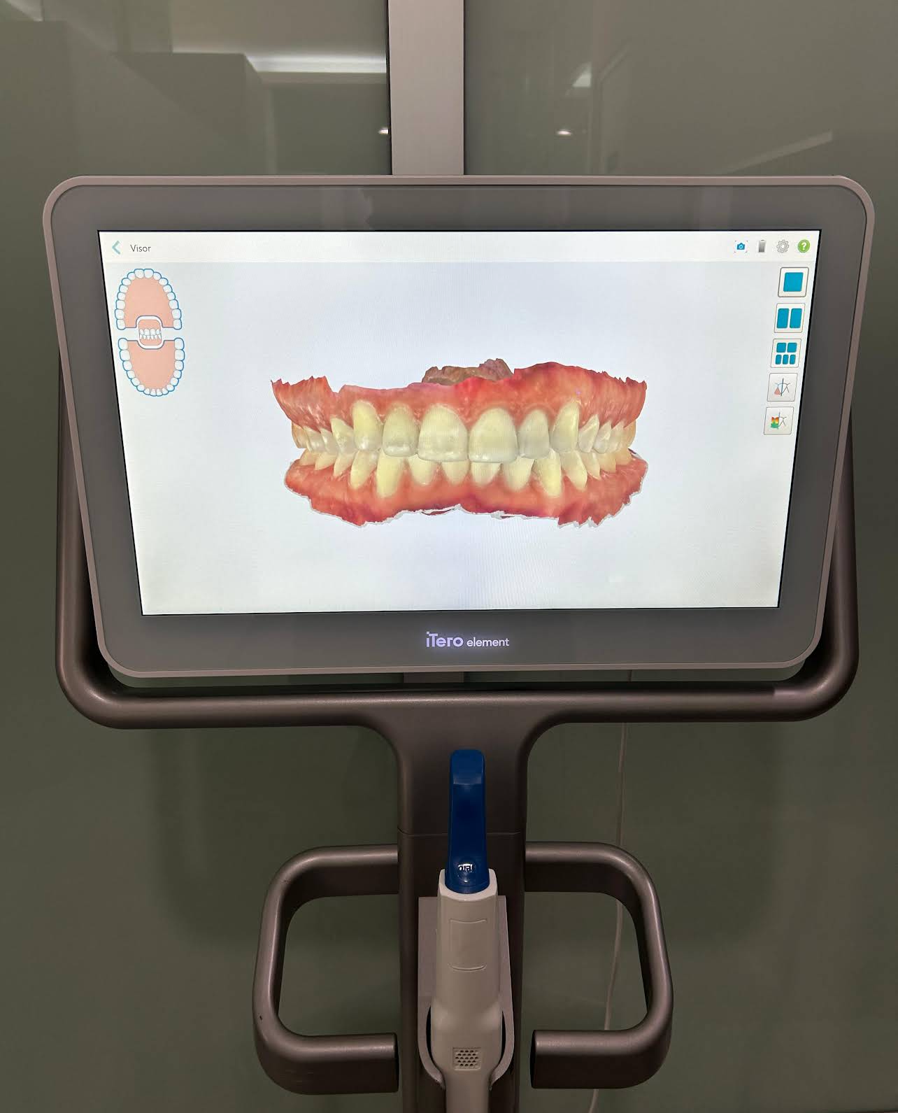 Escaneo dental