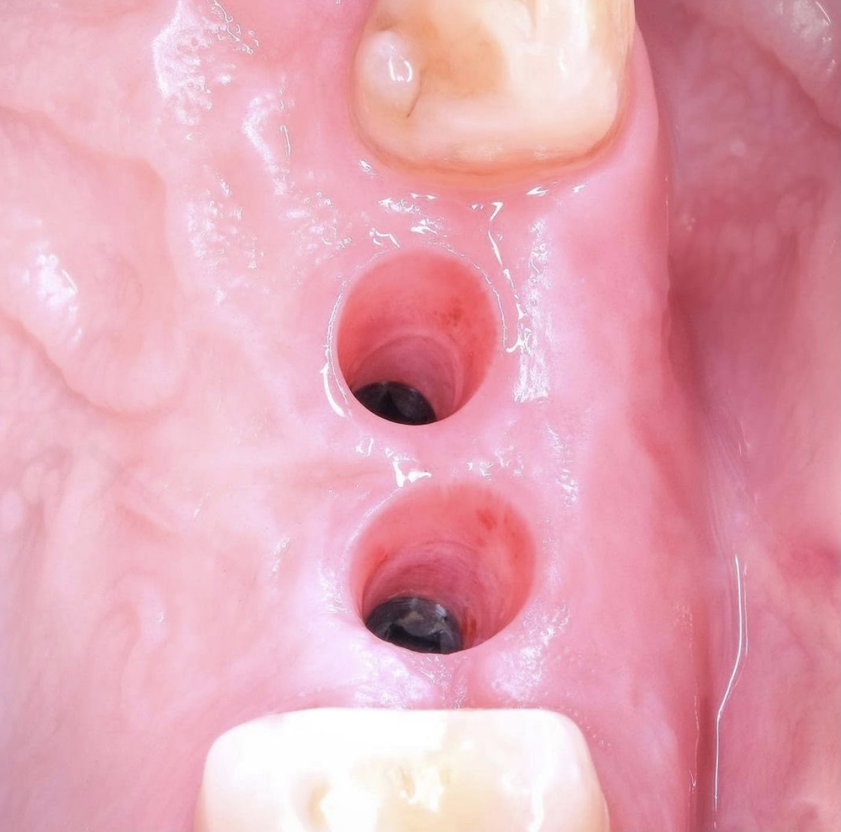 Escaneo dental