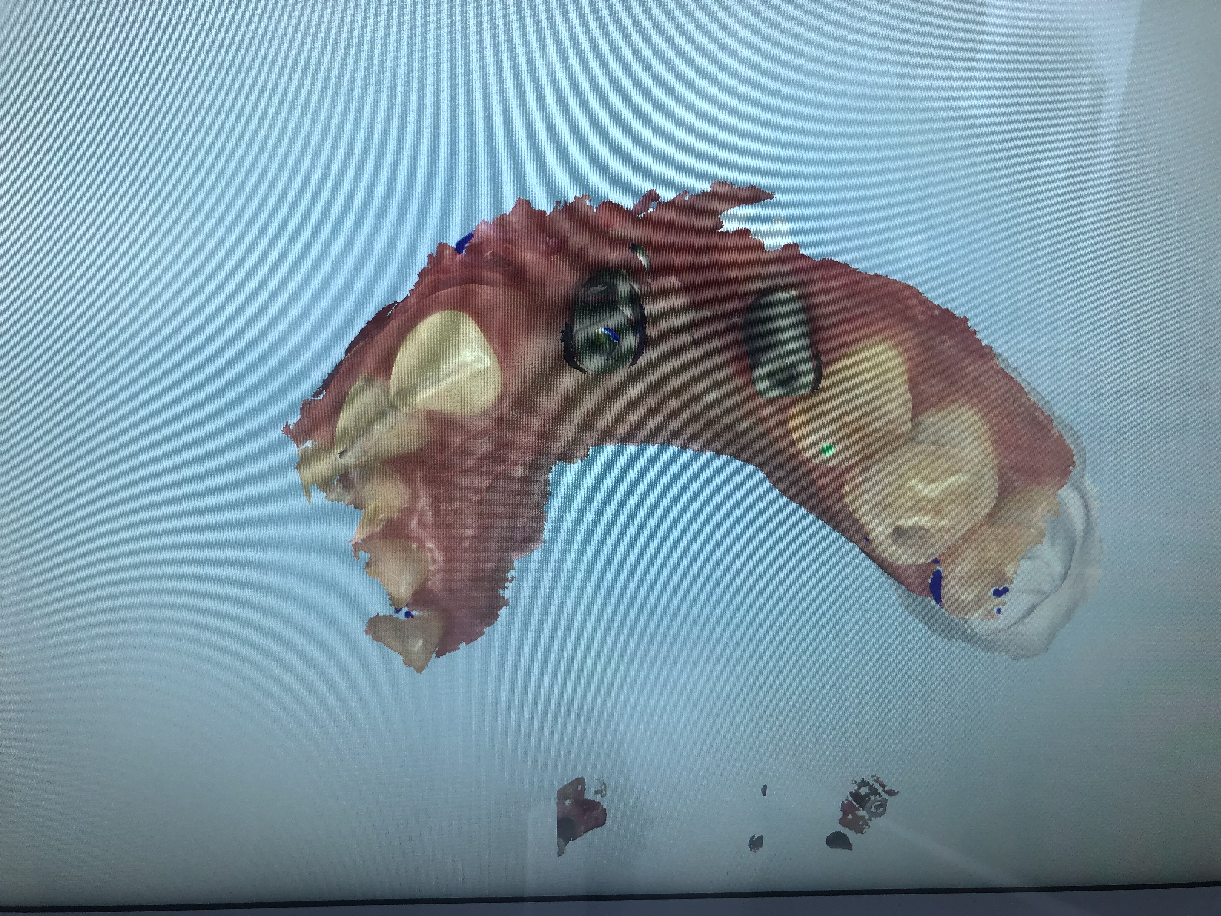 Escaneo dental