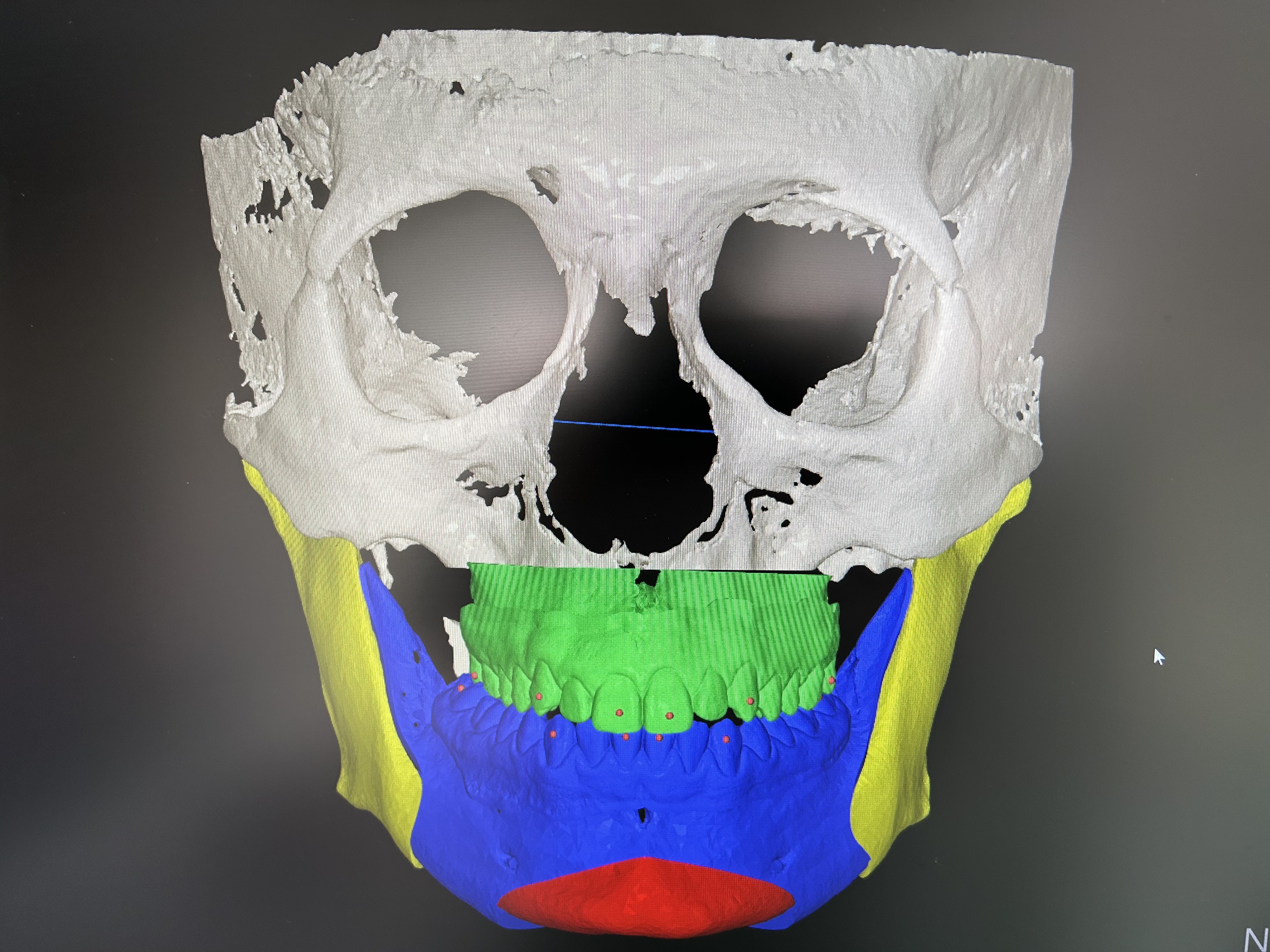Software para cirugía ortognática