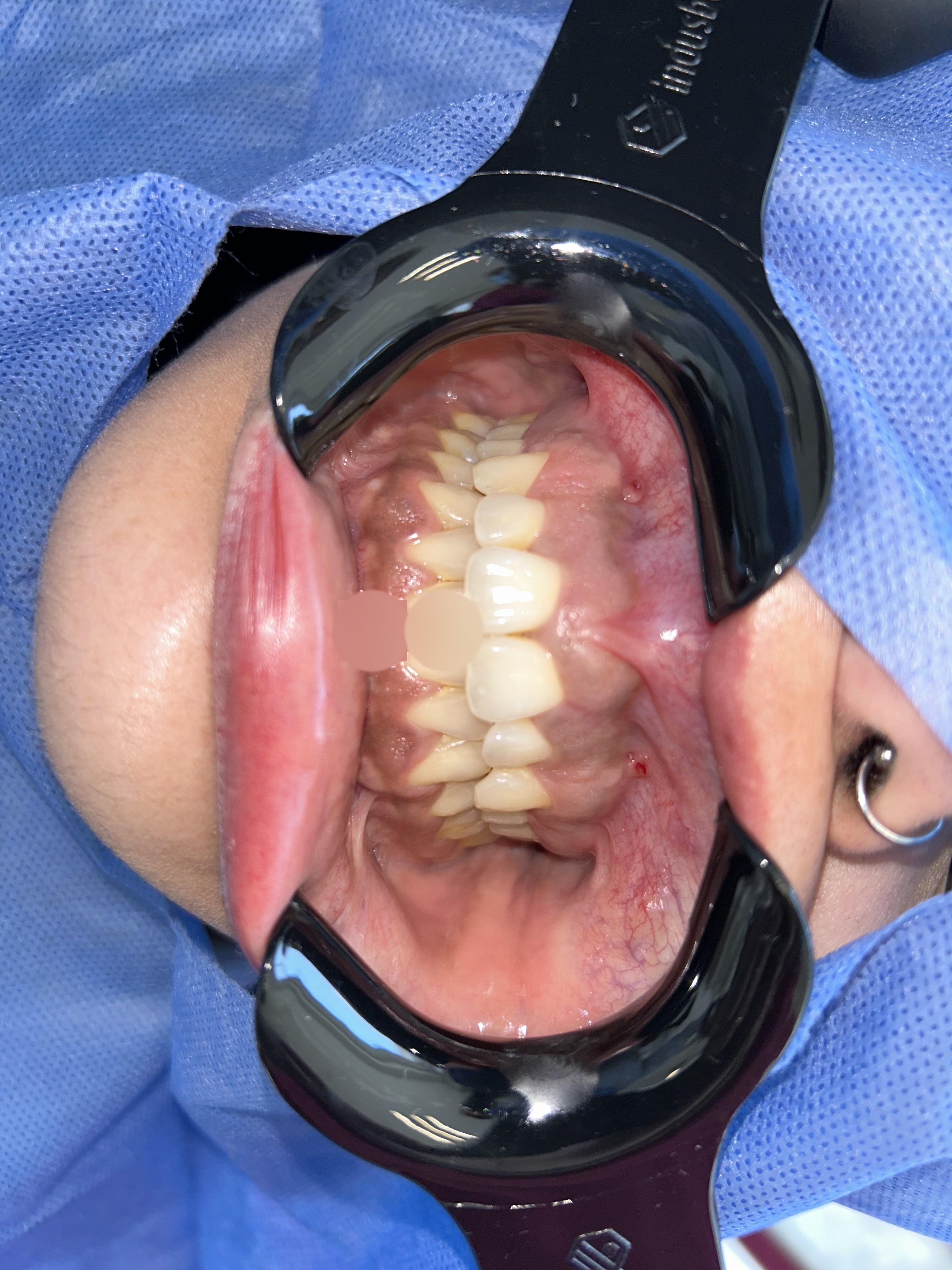Exostosis maxilar