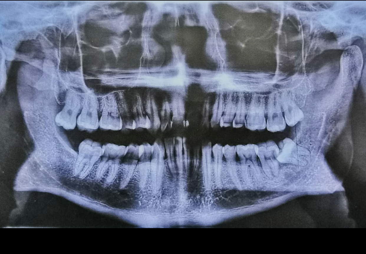 Second molar loss due to caries caused by a third molar