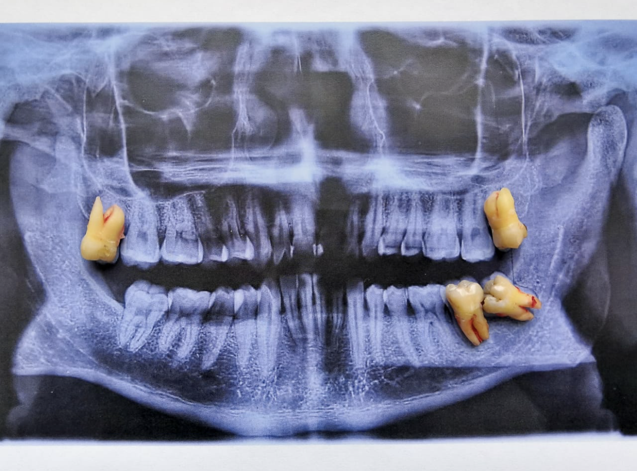 Second molar loss due to caries caused by a third molar