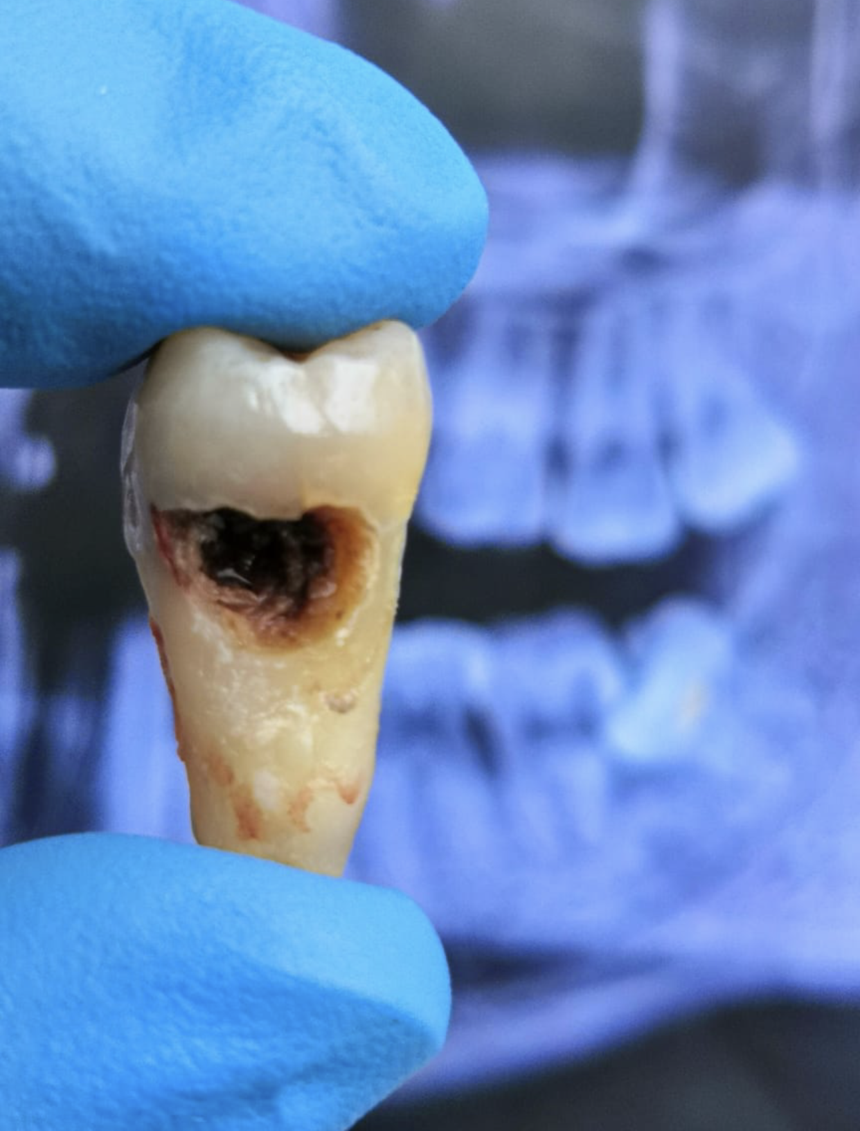 Second molar loss due to caries caused by a third molar