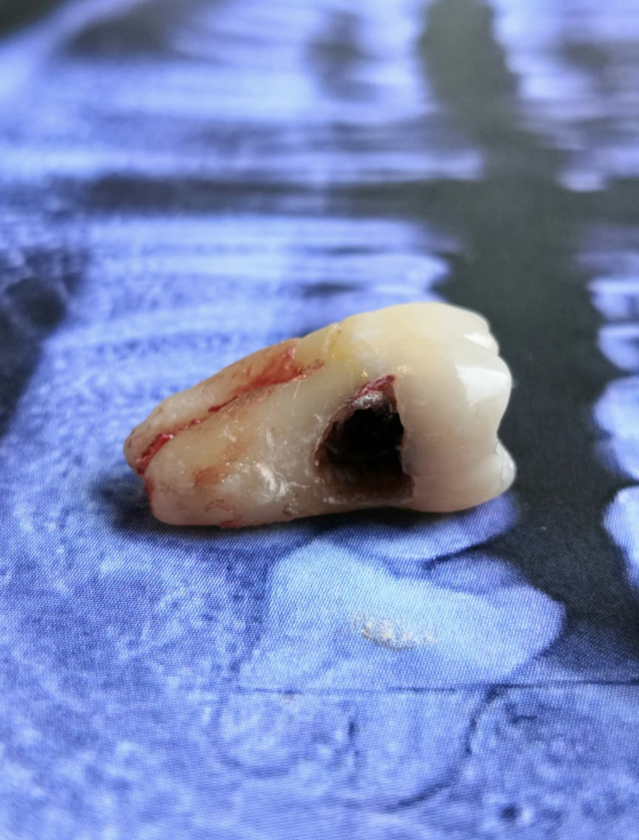 Second molar loss due to caries caused by a third molar