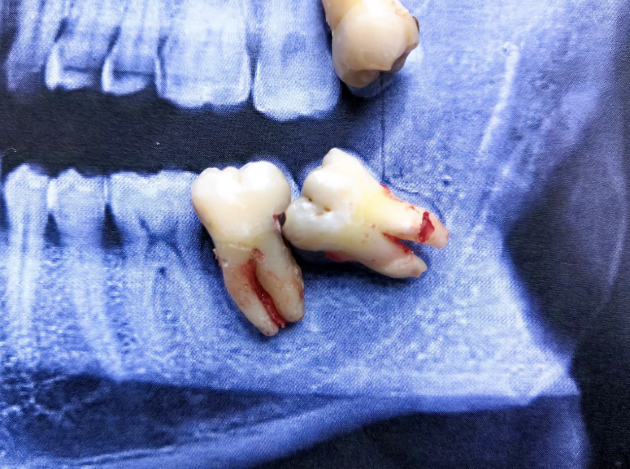 Second molar loss due to caries caused by a third molar