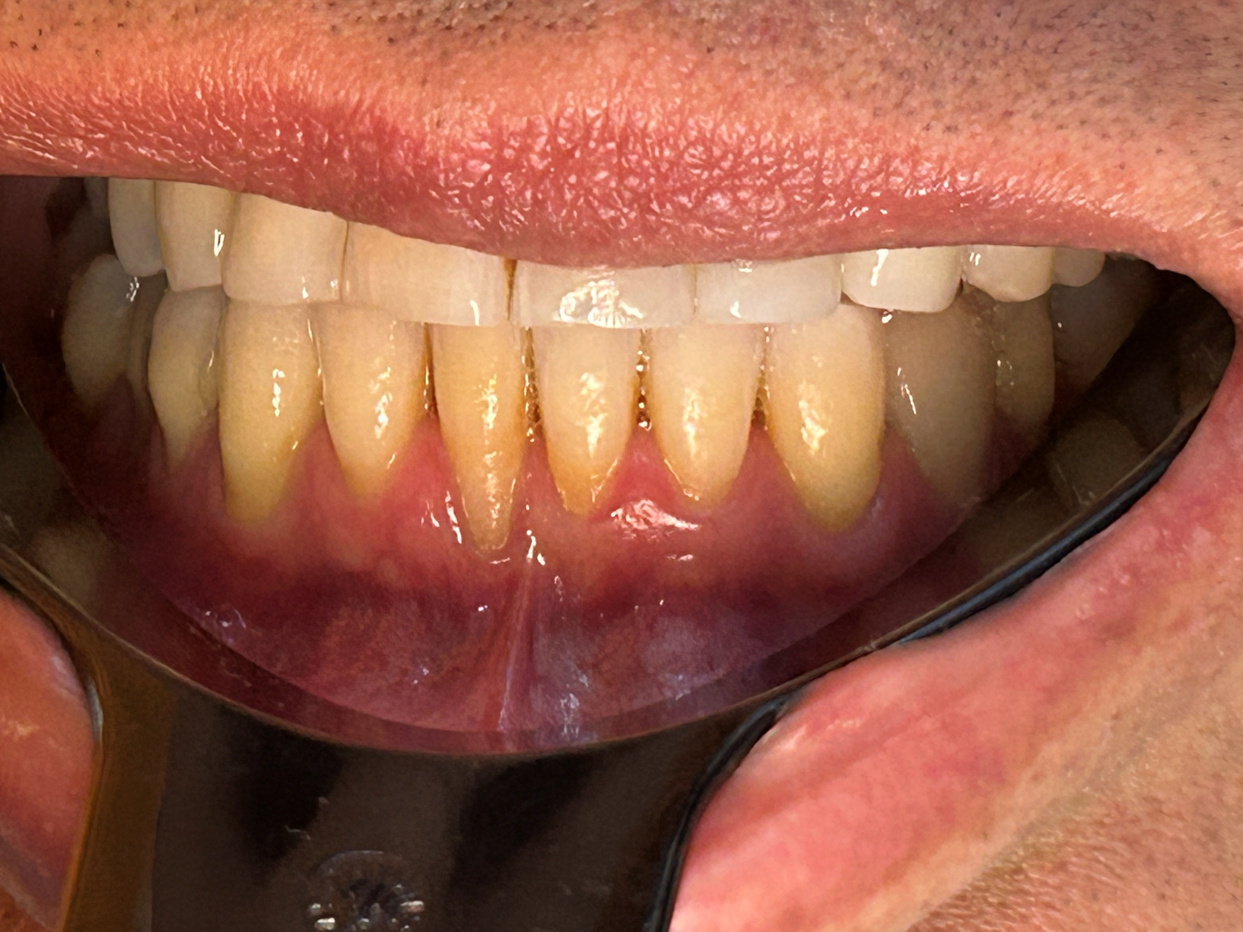 Frenillo labial inferior (retracción gingival)