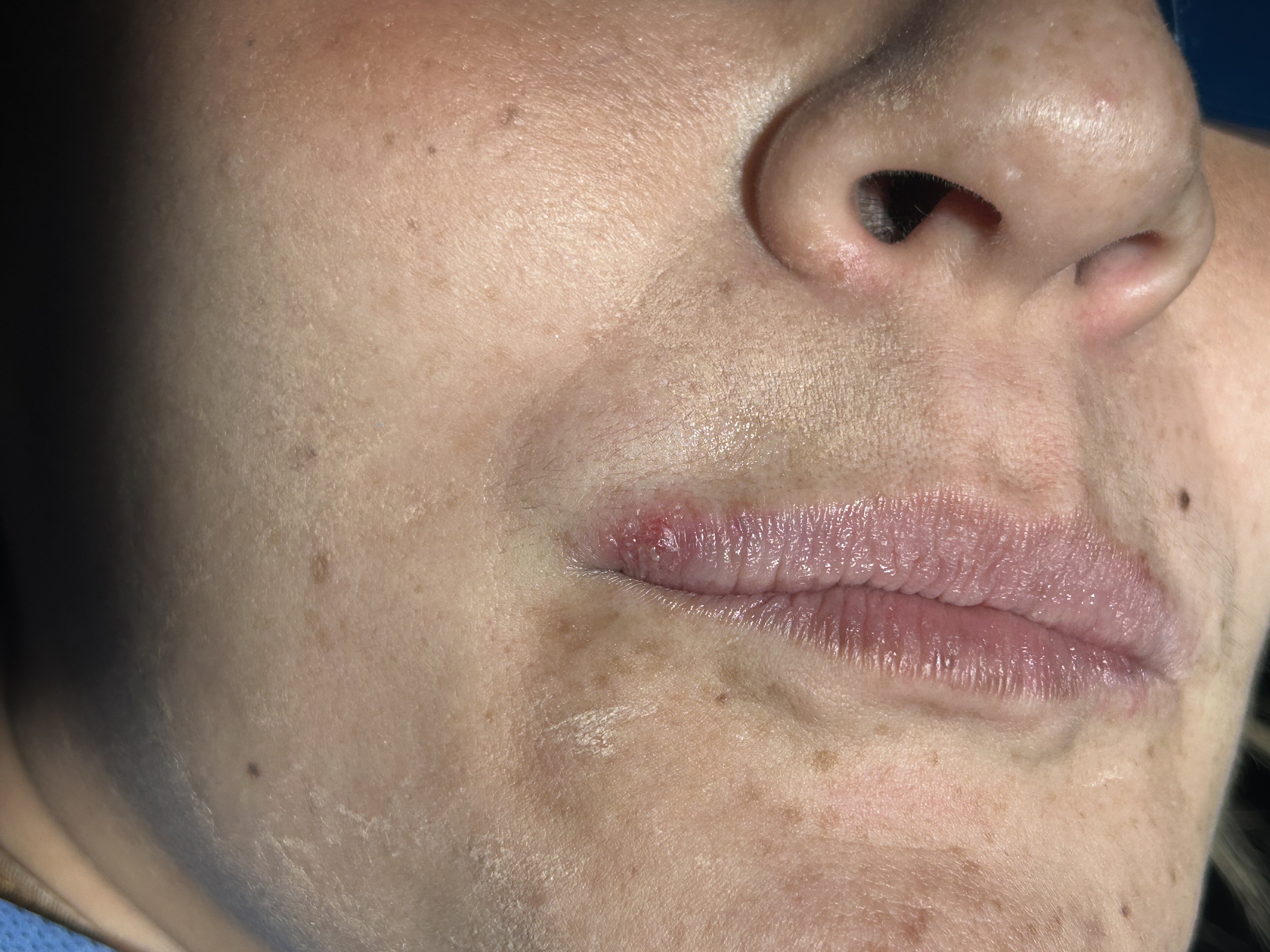 Herpes labial: caso